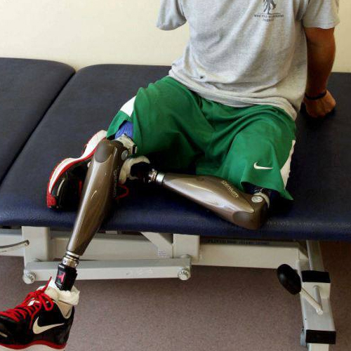 首次装配大腿假肢 截肢患者需要注意哪些事情？